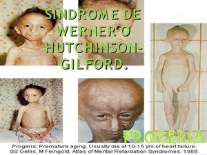 progeria 