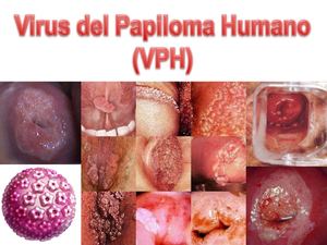virus del papiloma humano 