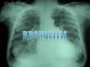 Bronquitis