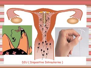 DIU (Bersit Gallardo)