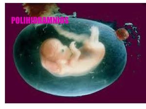 polihidramnios