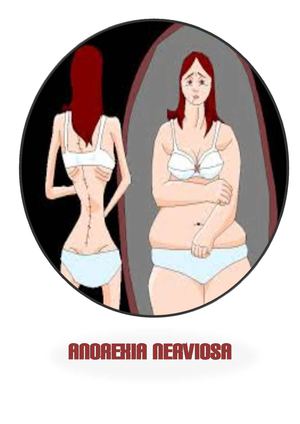 Anorexia nerviosa