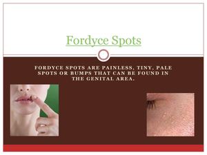 Fordyce Spots