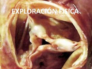 ESTENOSIS MITRAL 