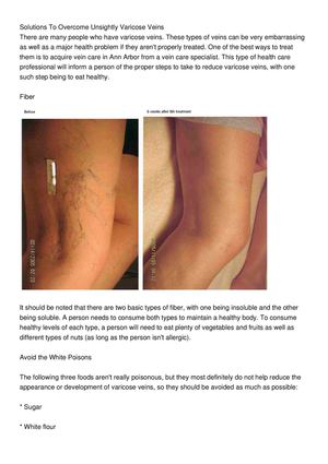 Solutions To Overcome Unsightly Varicose Veins