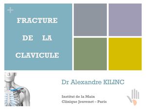 Fracture de la clavicule Dr Kilinc