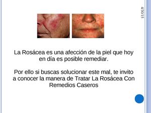 Tratar La Rosacea Con Remedios Caseros