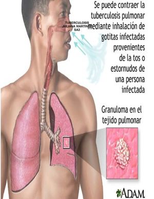 Tuberculosis