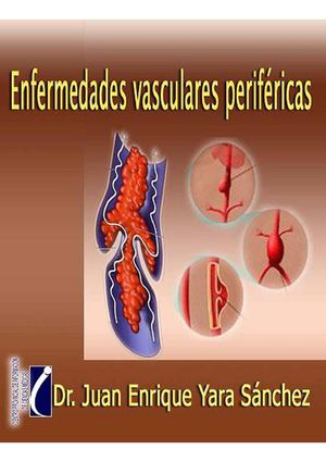 Enfermedades Vasculares Perifericas