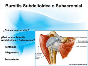 Expoo Bursitis Subacromial O Deltoidea