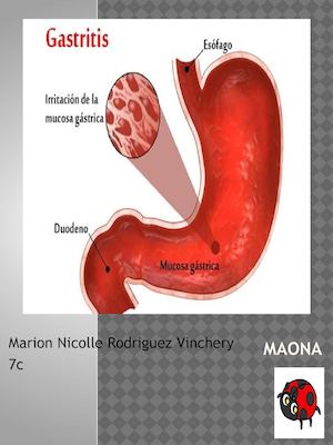 gastritis