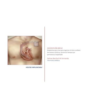 Holter Implantable