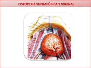 Cistopexia Abdominal Y Vaginal