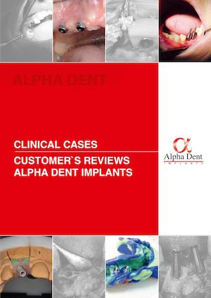 Alpha Dent Implants comments and case report book by international customers.
