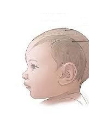 portafolio de la microcefalia