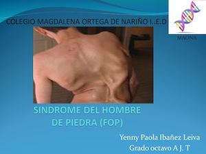 Portafolio Sindrome Del Hombre De Piedra