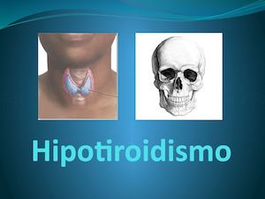 Hipotiroidismo Melany Rodriguez Pacheco