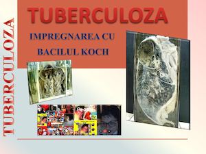 Tuberculoza