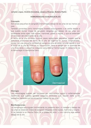Hemorragia Subungueal Y Examinación Cardiovascular