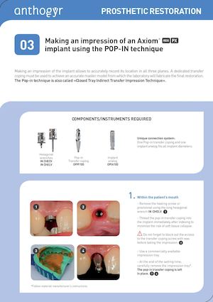 Impression of an Axiom® REG & PX using the Pop-In technique GB