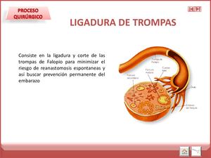Ligadura De Trompas Pomeroy Irving Ushida
