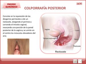 Colporrafia Posterior Correccion Rectocele