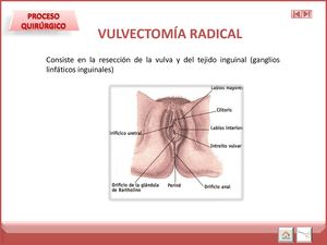 Vulvectomia Radical