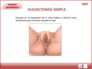Vulvectomia Simple
