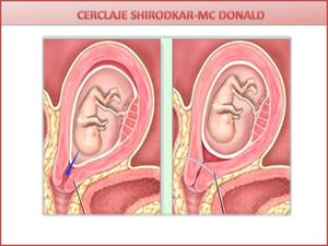 CERCLAJE CUELLO UTERINO