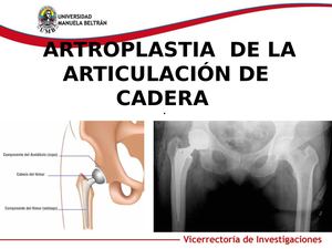 Atroplastia De La Articulación De Cadera