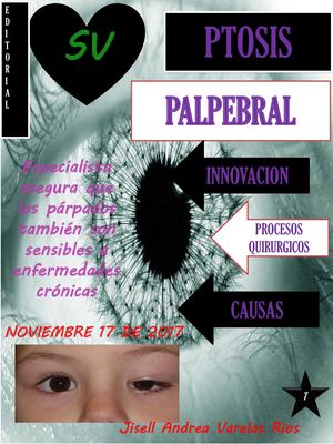 LA PTOSIS PALPEBRAL