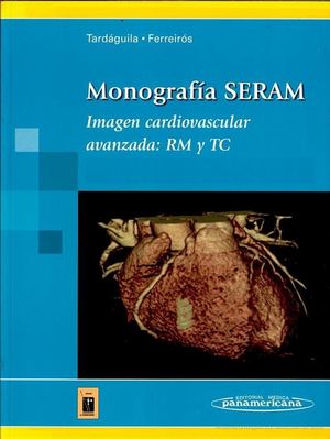 hipertrofia lipomatosa de los síntomas del tabique interauricular de diabetes