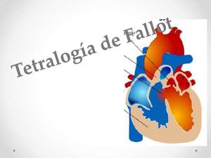 Tetralogadefallot