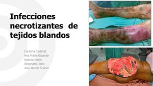 Infecciones Necrotizantes