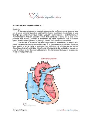 Ductus Arterioso Persistente