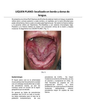 Liquen Plano Patologia