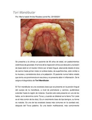 Tori Mandibular Investigación