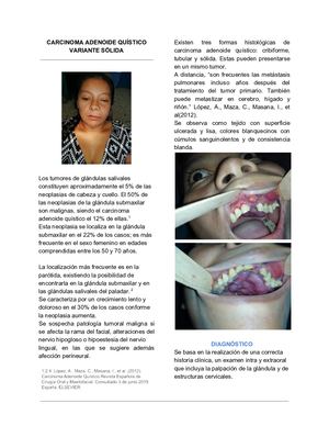 Carcinoma Adenoide Quístico