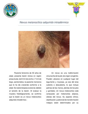 Nevus Melanocítico Adquirido Intradérmico