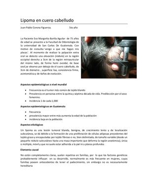 lipoma en cuero cabelludo patologia