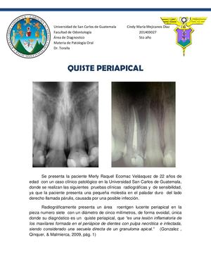 Quiste Periapical