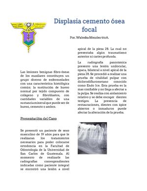 Displasia Cemento Osea Focal