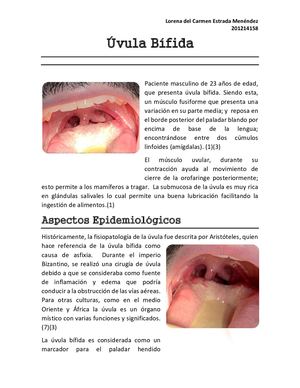 Úvula Bífida