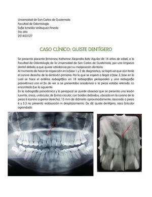 Caso Cínico Quiste Dentígero