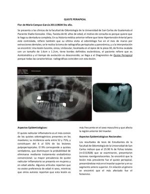 Quiste Periapical