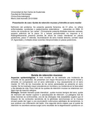 Quiste de retención mucoso y Antrolito