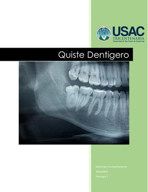 Quiste dentigero Patología