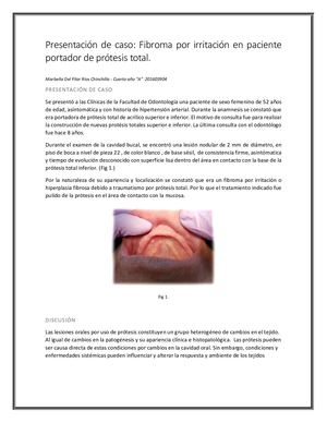 Fibroma por irritación