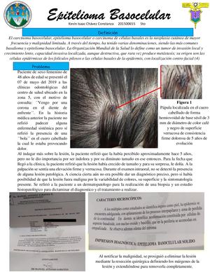 Epitelioma Basocelular