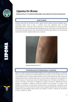 Lipoma En Brazo